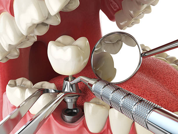 Best Broken or Chipped Tooth Repair in New Sarpy, LA